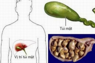 Ngăn ngừa sỏi mật bằng mẹo đơn giản